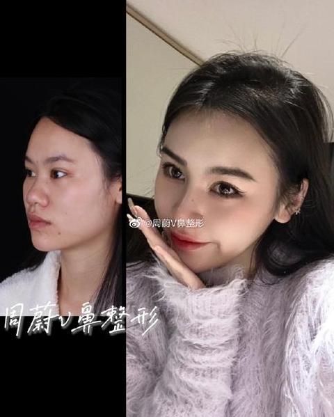 小米粥进入鼻子里面
